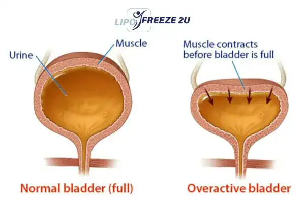 diagram of overactive bladder treatment Paisley
