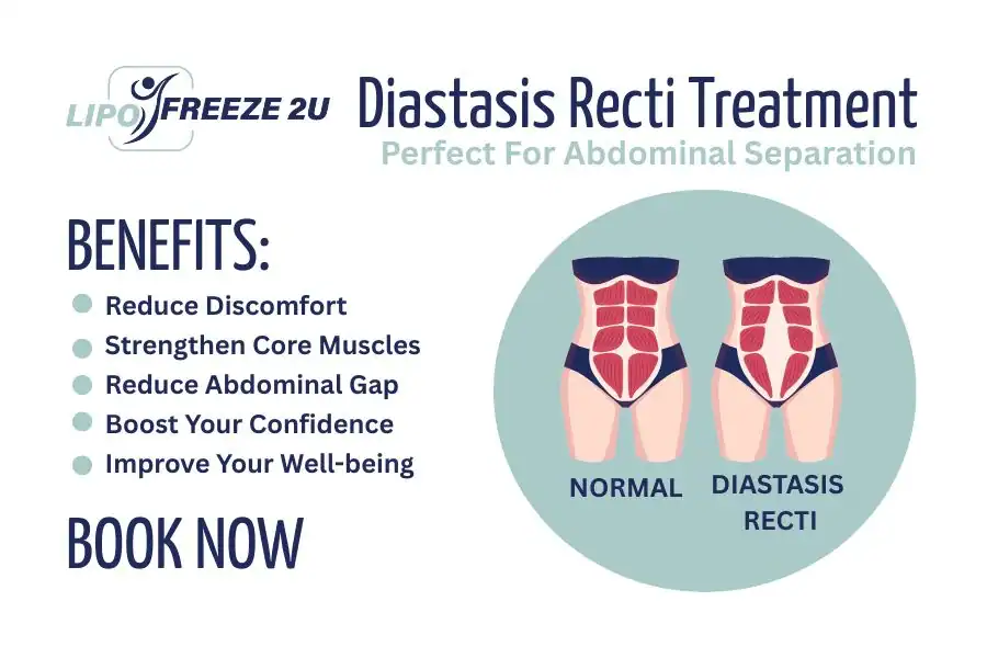 Benefits of body toning treatment Paisley for Diastasis recti