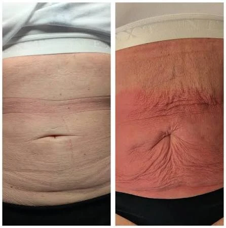 How Does RF Microneedling Improve Crepey, Thin and Uneven Skin Texture Paisley?