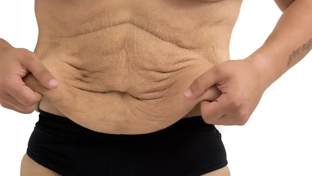 RF Microneedling for Loose Skin: How Can It Help Tighten and Reshape the Skin Paisley?